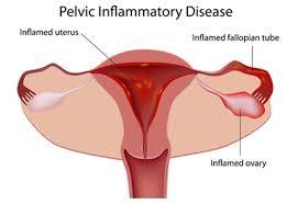 Not all women with pid have noticeable symptoms. Pelvic Inflammatory Disease Pid Causes Signs Ayurvedic Treatment