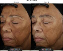 A randomized, controlled, split-face, double-blind comparison of a  multimodality pigment-correcting serum containing lotus sprout extract  versus hydroquinone for moderate to severe facial hyperpigmentation,  including melasma, in a diverse population ...