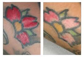 What does an infected tattoo look like? Tattoo Skin Reactions Allergies And Infections