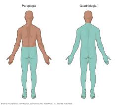 Spinal Cord Injuries Paralysis Of The Lower Half Of The Body Is Called Paraplegia Paralysis Below The Neck Including Bo Spinal Cord Injury Spinal Paraplegia