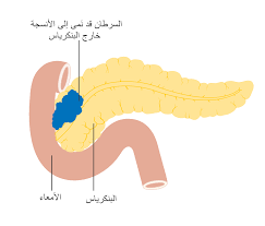 Maybe you would like to learn more about one of these? File Diagram Showing Stage T3 Cancer Of The Pancreas Cruk 261 Ar Svg Wikimedia Commons