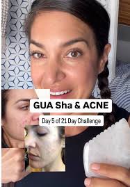 Gua Sha Tips for Managing Adult Acne Prone Skin