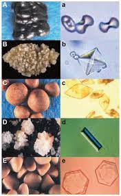 La présence de cristaux d'oxalate de calcium avec un examen cytobactériologique des urines (ecbu) n'a aucune valeur car le plus souvent ce sont des dépôts qui se forment dans le tube. Divers Lithiase Renaux Cristaux Doxalate De Calcium Dans Les Urines Symptomes