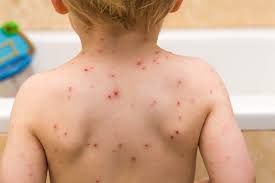 Image result for Varicella zoster on human skin