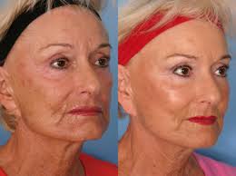 However, individual results may vary. Sculptra For Naples Fort Myers Fl Kent V Hasen Md Aesthetic Plastic Surgery Med Spa Of Naples
