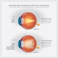 How do you know if they're the right length? Cataract Symptoms And Causes Cataract Eye Cataract Cataract Symptoms
