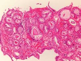 Image result for Prostate Cancer Histologic grading