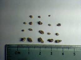 Kidney Stones Come In Many Different Sizes In 2020 Kidney Stones Symptoms Kidney Stones Remedy Passing Kidney Stones