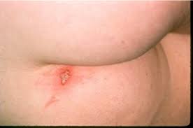 Image result for genital herpes