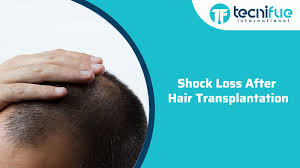 They claim it can reduce initial shedding after hair transplant and help in hair growth after transplant. Hair Transplant Blog Page 2 Of 72 Tecnifue Best Hair Transplant