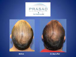 I have retrograde alopecia, which means i loose hair on the top (classic male pattern baldness recession) but also at the sides and the back (mainly at the nape of neck, i still have a small donor zone, that's why i think i have retrograde alopecia instead. Acell Prp Hair Rescue In Only 21 Days Nyhairloss Com