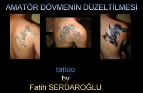 Bölgeye su uygulandıktan sonra, tasarım daha çabuk ortadan kaybolacaktır). Op Dr Oytun Idil Www Kozmetikcerrahi Com
