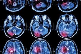 Image result for Brain Lesion