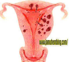 Tanda atau gejala awal kanker serviks perlu diketahui sebagai langkah pencegahan agar kerusakan sel tersebut bisa segera ditangani. Pengobatan Penyakit Kelamin Anda Perlu Mengetahui Tanda Tanda Gejala Kanker Serviks