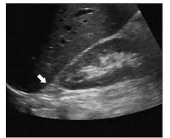 Normal Adrenal Gland In A 15 Year Old Boy Arrow The Cortex And Medulla Cannot Be Seen Separately And The Gland I 15 Year Old Boy Boys Arrows Adrenal Glands