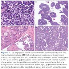 Broadly speaking they may be: Morphologic Immunophenotypic And Molecular Features Of Epithelial Ovarian Cancer