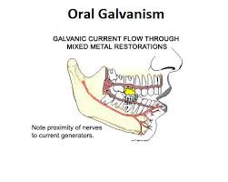 Oral Galvanism Dentagama Dental Life Oral Dental