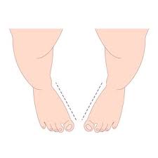 Image result for In-Toeing