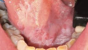Image result for white cancer on tongue)