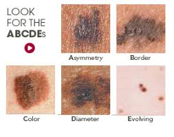 This could be a new growth, a sore that doesn't heal, or a change in a mole. Symptoms Midwest Dermatology Midwest Dermatology