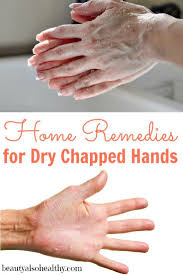 Home Remedies For Dry Chapped Hands Chapped Hands Home Remedies Remedies