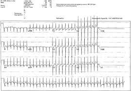 Ptosis induced by topical steroid eye drops: Necrotising Enterocolitis After Supraventricular Tachycardia An Unusual Precursor To A Common Problem Bmj Case Reports