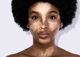 Image result for Vitiligo