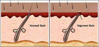 Still, these pesky little guys can make a very much unwanted appearance with waxing. Prevent In Grown Hair After Waxing