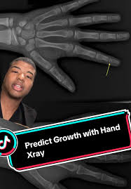 Image result for Hand Growth Plates