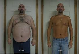 What if i see blood in the stool after gastric bypass surgery? Rny Gastric Bypass Before And After Album On Imgur