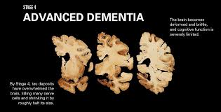 Chronic traumatic encephalopathy (cte) is a progressive brain condition that's thought to be caused by repeated blows to the head and repeated episodes of concussion. How Cte Affects The Brain League Of Denial The Nfl S Concussion Crisis Frontline Pbs Official Site