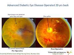 We have expertise in nearly every eye condition including diabetic eye disease, glaucoma, macular degeneration, retinal diseases, cataracts, and corneal disease. Drushti Eye And Retina Center Advanced Diabetic Eye Disease Operated 20 Yrs Back