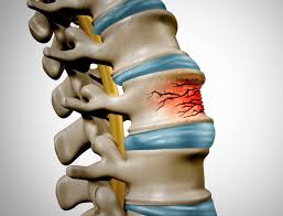 Image result for Vertebral Compression Fracture