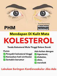 Merupakan sejenis lipid yang merupakan molekul lemak atau yang menyerupainya. Public Health Malaysia Xanthelasma Atau Mendapan Kolesterol Di Kulit Adalah Tanda Kolesterol Tinggi Dalam Darah Ianya Juga Boleh Disebabkan Faktor Umur Kolesterol Tinggi Dikaitkan Dengan Pelbagai Penyakit Seperti Darah Tinggi Jantung
