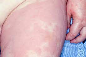 Hives Nhs