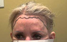 Apart from age hair loss or alopecia can be the cause too. Womens Haircuts For Receding Hairline Novocom Top