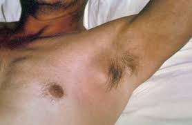 Armpit hair is at the forefront of this. Men Are Getting Armpit Hair Transplants Because They Re Insecure About It Not Being Thick And Manly Enough The Frisky