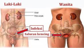 Anda mungkin perlu mulai waspada. Sakit Saat Buang Air Kecil Waspadai Anyang Anyangan Berikut Solusinya Badak Pos Com