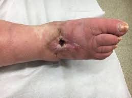 Image result for erysipel photos)