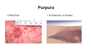 The bleeding causes the petechiae to appear red, brown or purple. Purpura And Vasculitis Ppt Video Online Download