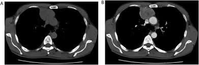 Diaphragmatic invasion, ascites, and omental caking are common ct scan findings of peritoneal mesothelioma. Localized Malignant Pleural Mesothelioma Mimicking An Anterior Mediastinal Tumor Sciencedirect