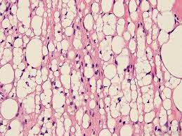 Endobronchial Lipoma Microscopic Respiratory Diseases Lung Sounds