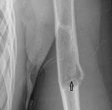 Fallen fragment sign