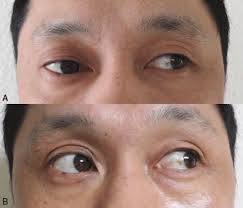 The differential diagnosis is complex and evaluation may. A The Patient Had Diplopia When Looking Left B His Limited Download Scientific Diagram
