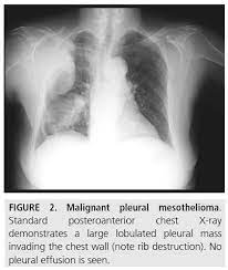 Mesothelioma on chest x ray. Diagnostic Imaging And Workup Of Malignant Pleural Mesothelioma