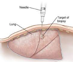 Ct Guided Lung Biopsy