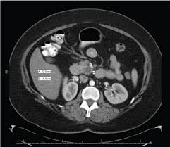 Über 7 millionen englische bücher. Irreversible Electroporation Of Locally Recurrent Pancreatic Cancer With 5 Year Survival