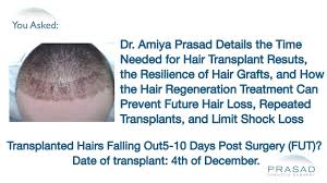 This shock loss can start as early as 10 days following transplantation. Time Needed For Hair Transplant Results And How To Limit Shock Loss And Stop Future Hair Loss Youtube