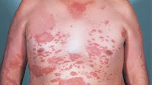 Nagy örömünkre szolgál fellépőként bejelenteni az iac jeles képviselőjét, a szegedi lepra zenekart, akiknek előreláthatóan ez lesz az egyetlen idei budapesti fe.llépése! Las 14 Datos Clave Para Conocer Todo Sobre La Lepra En La Argentina Infobae