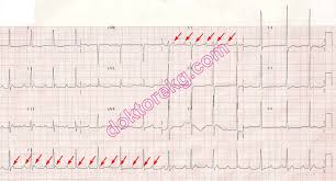 It is not every day you get to see a classic ekg finding for pulmonary embolism. Acute Pulmonary Embolism Embolus Akut Pulmoner Embolizm Emboli Ekg Ecg Ankara Kardiyoloji Kalp Hastaliklari Mete Alpaslan Doktorekg Com